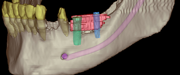 Digitale Volumenthomographie unterstützt bei der Planung und hilft wirkungsvoll, Komplikationen zu vermeiden.