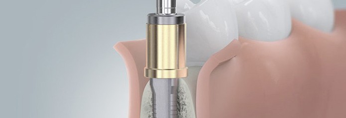 implantation_setzten2