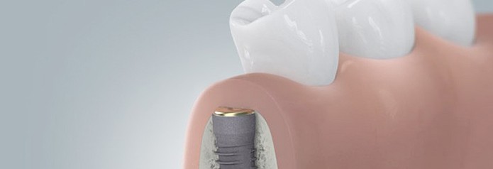 implantation_setzten3