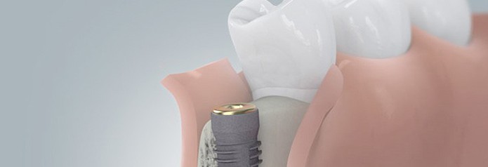 implantation_setzten4