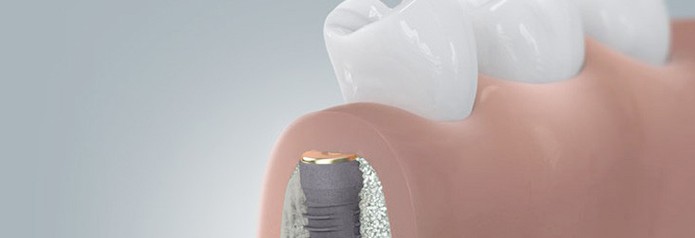 implantation_setzten5