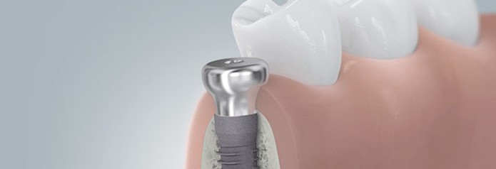 implantation_setzten6